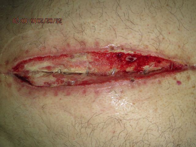 Deep sternal wound infection at presentation