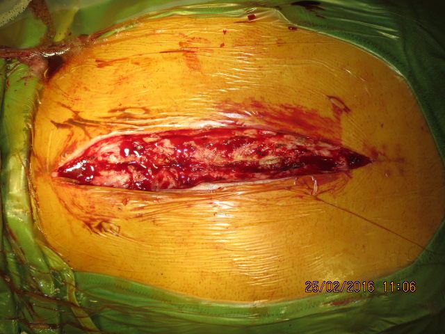 Debridement with exposed sternum