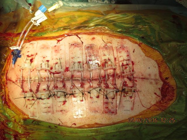 CITA and TopClosure during treatment