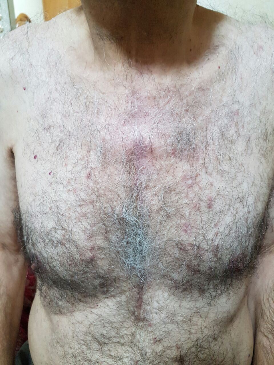 Healed chest wall