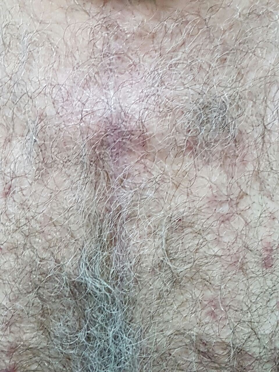 Healed sternal wound close-up
