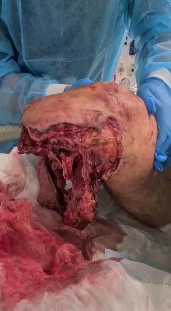 Initial crush degloving injury