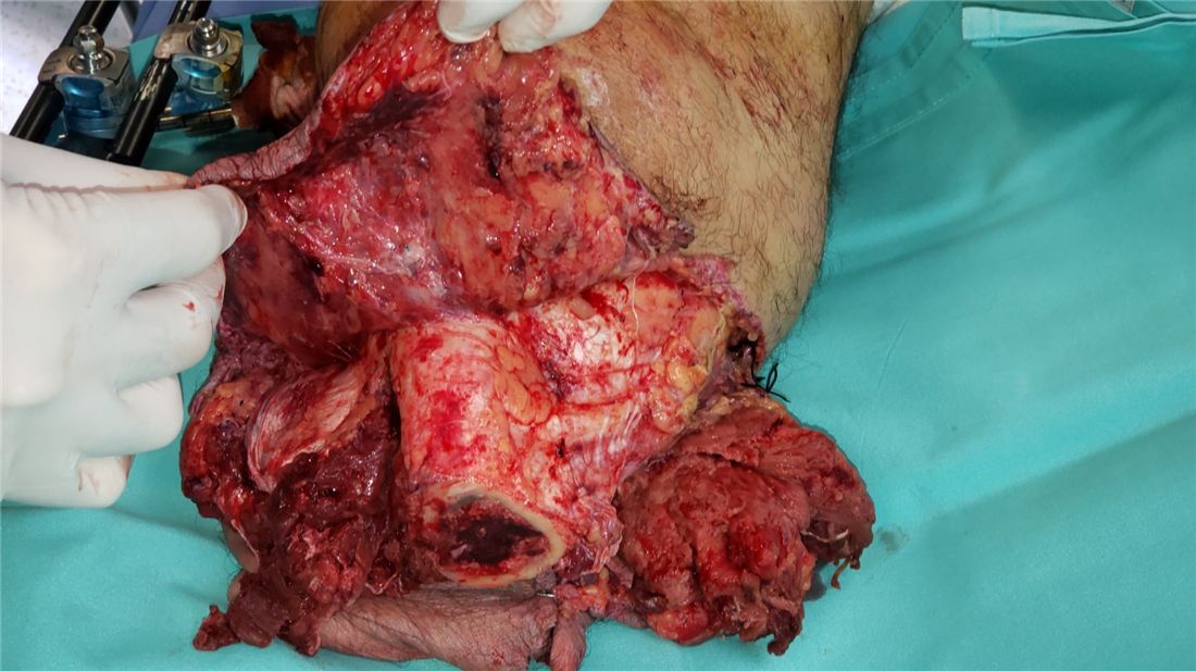 Extensive soft tissue destruction