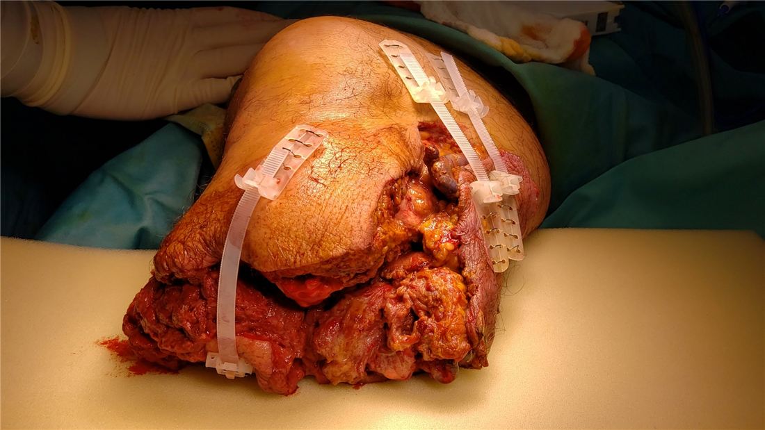 Early stabilization with TopClosure