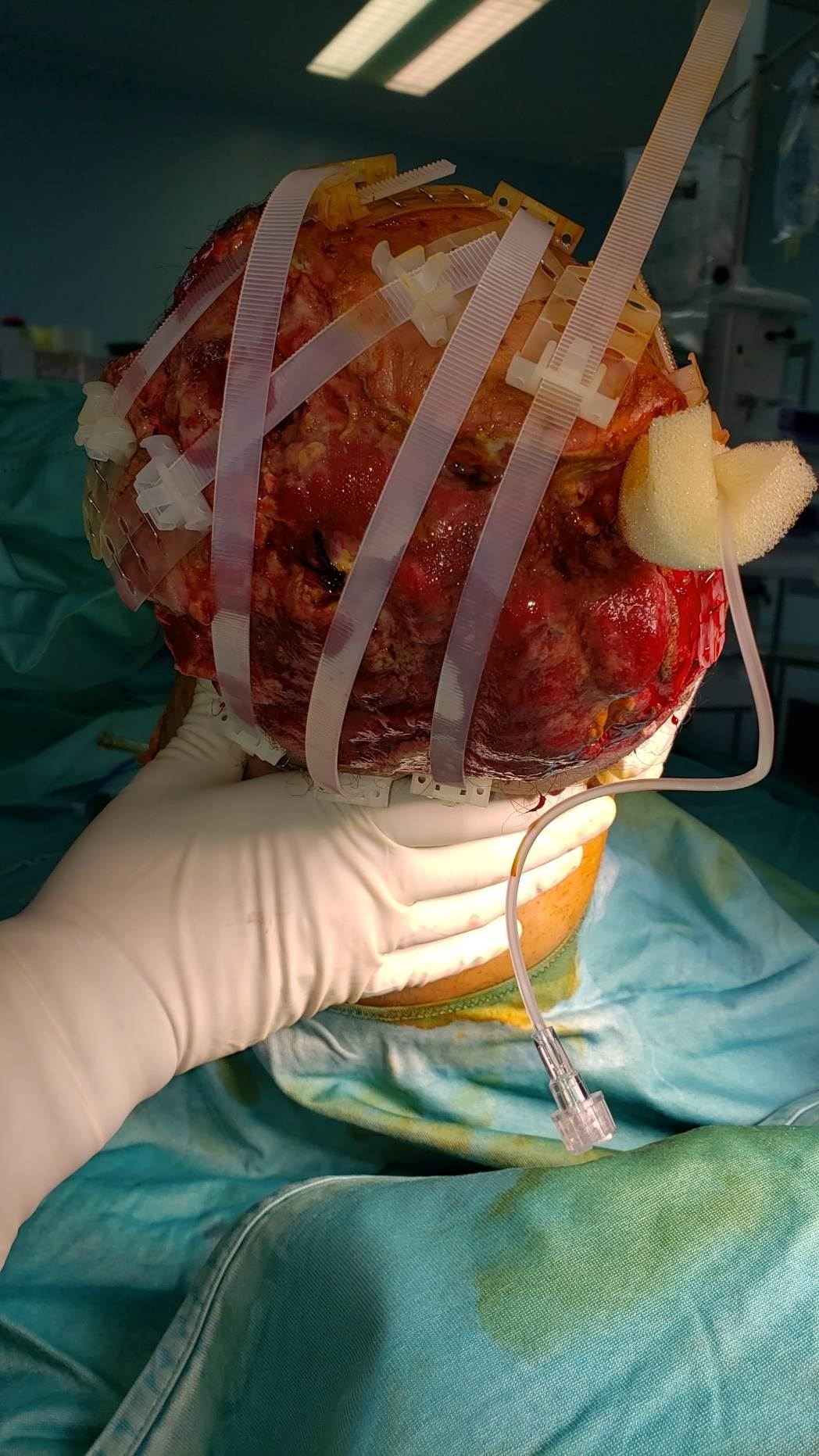 Immediate wound stabilization with TopClosure
