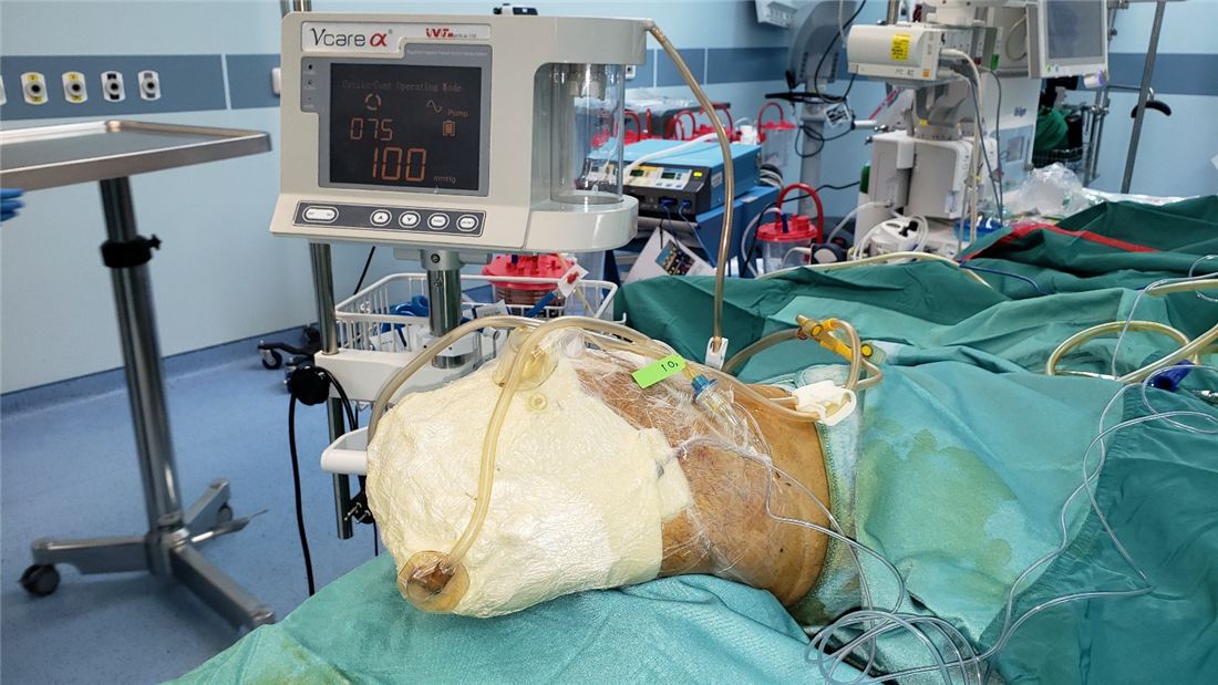Regulated NPWT with Vcare in the operating room