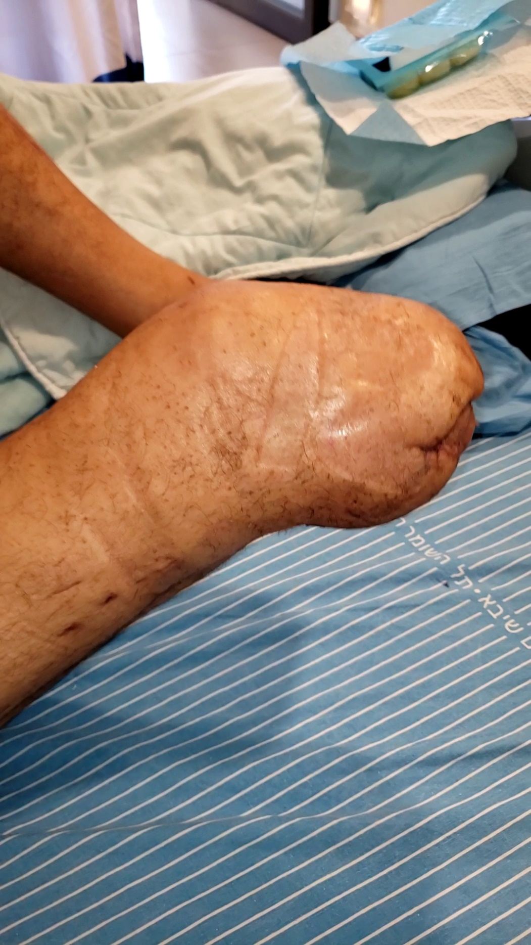Healed below-knee stump
