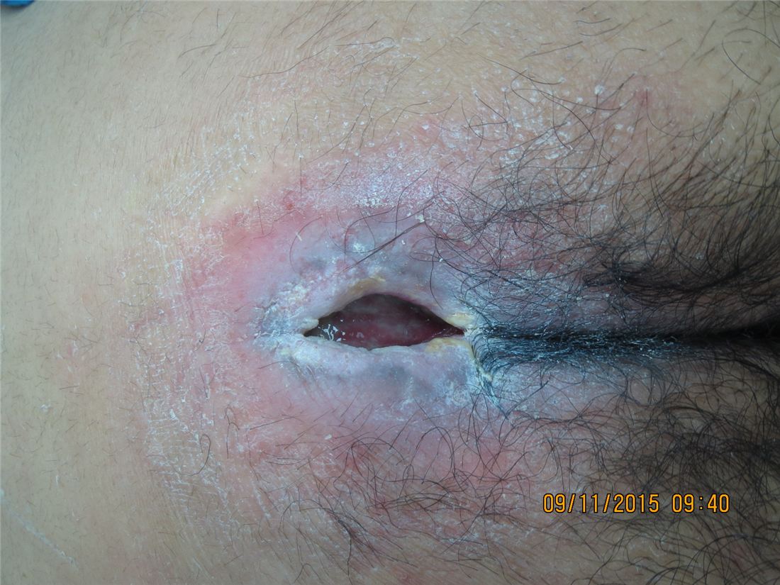 Advanced pressure ulcer at baseline