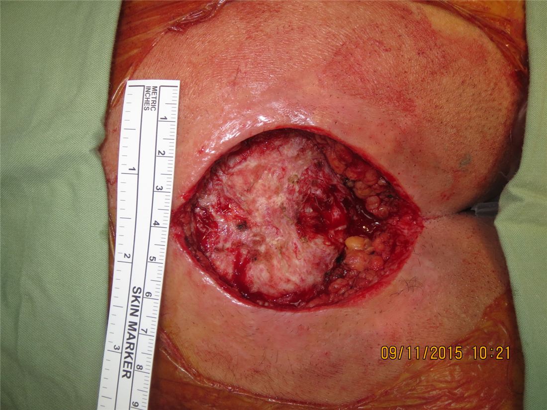 Deep tissue destruction after debridement