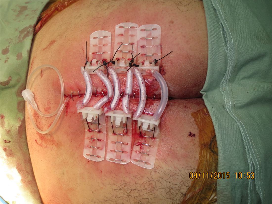 TopClosure and CITA application