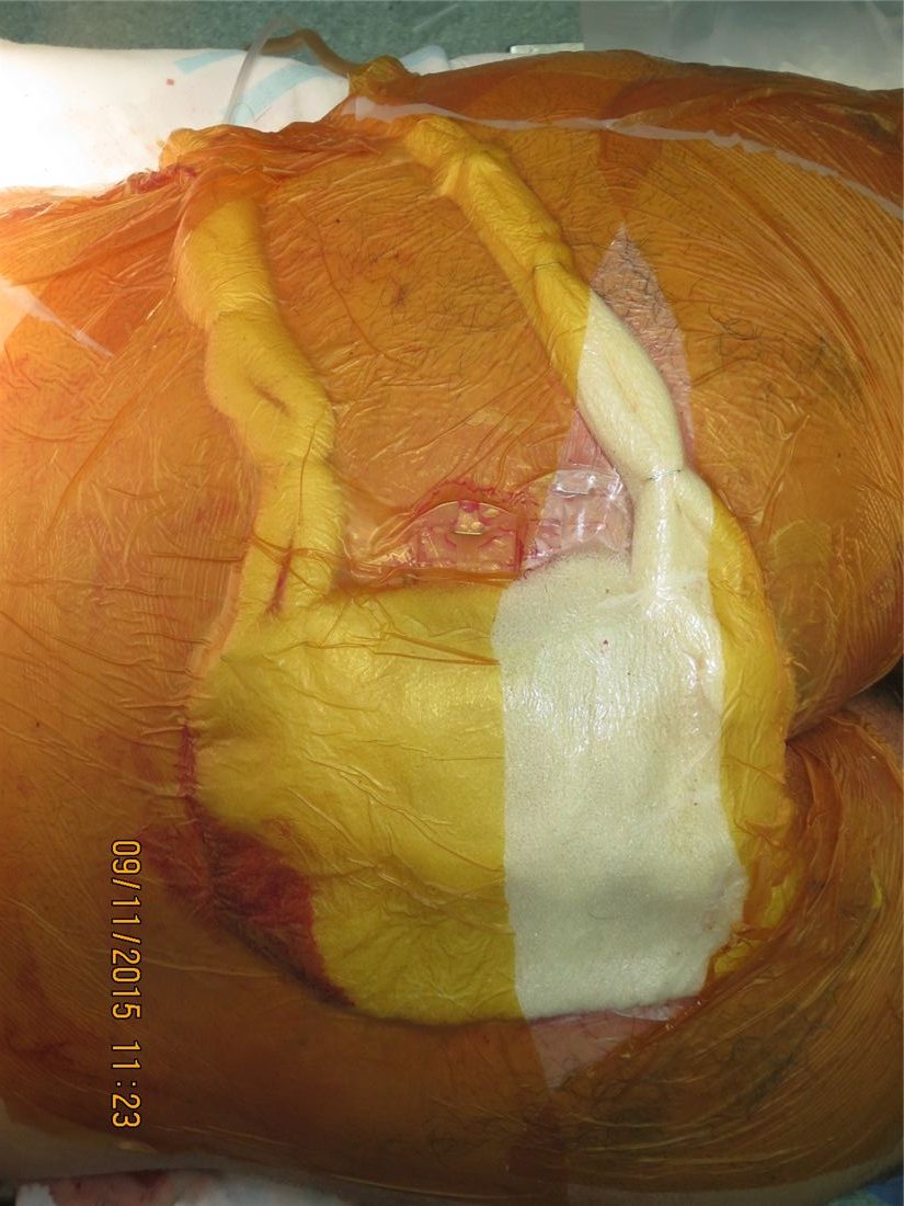 ROI-NPT controlled wound environment