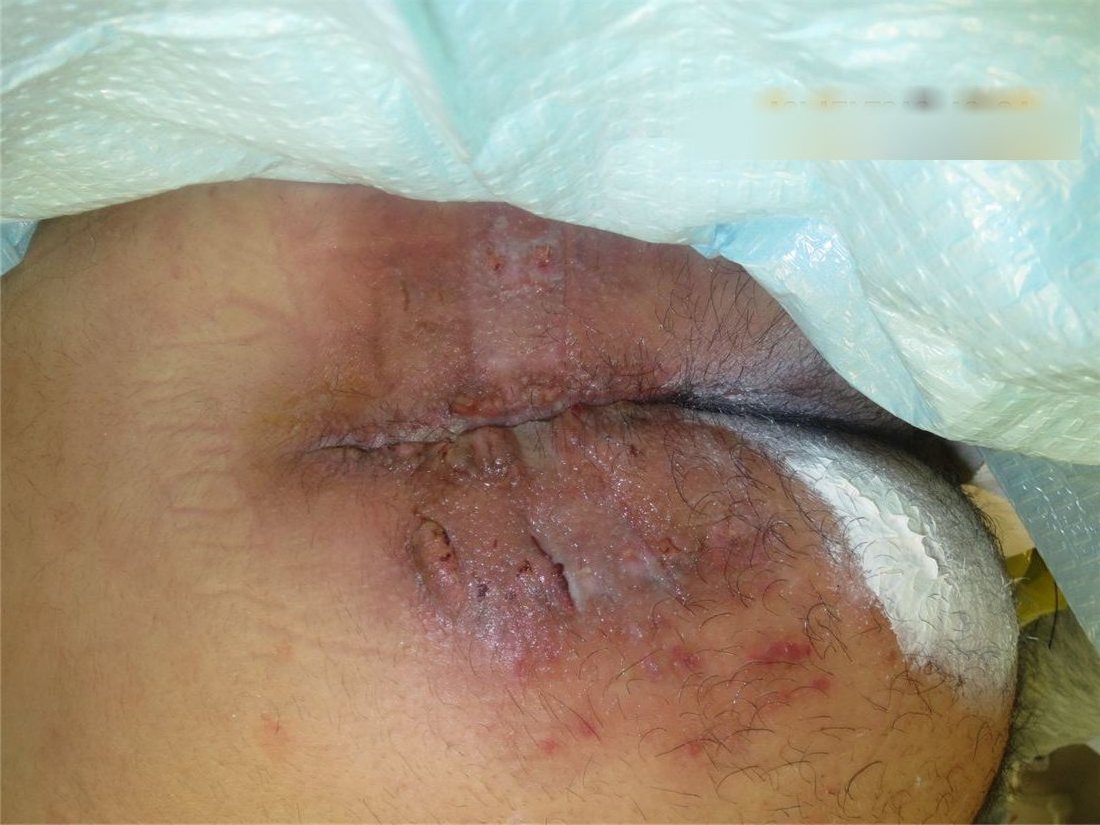 Progressive wound closure