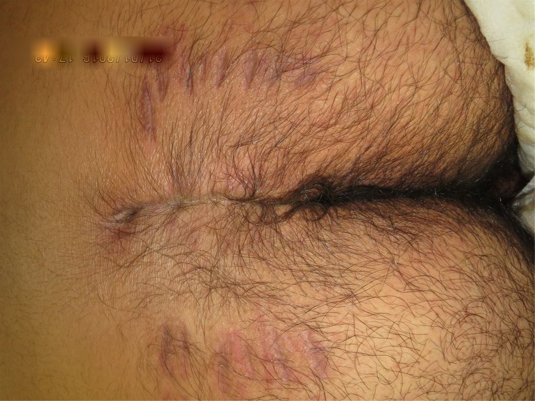 Healed wound after reconstruction