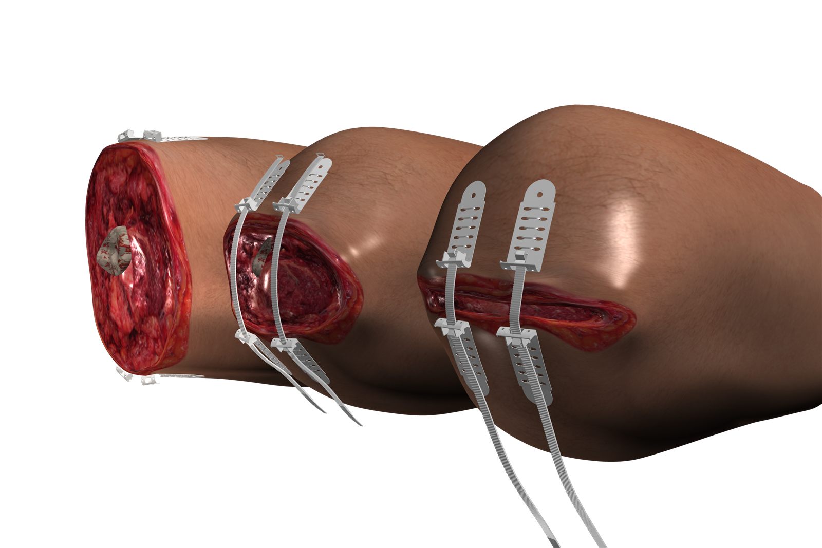 TopClosure® TRS applied to severe soft tissue injuries of a lower limb
