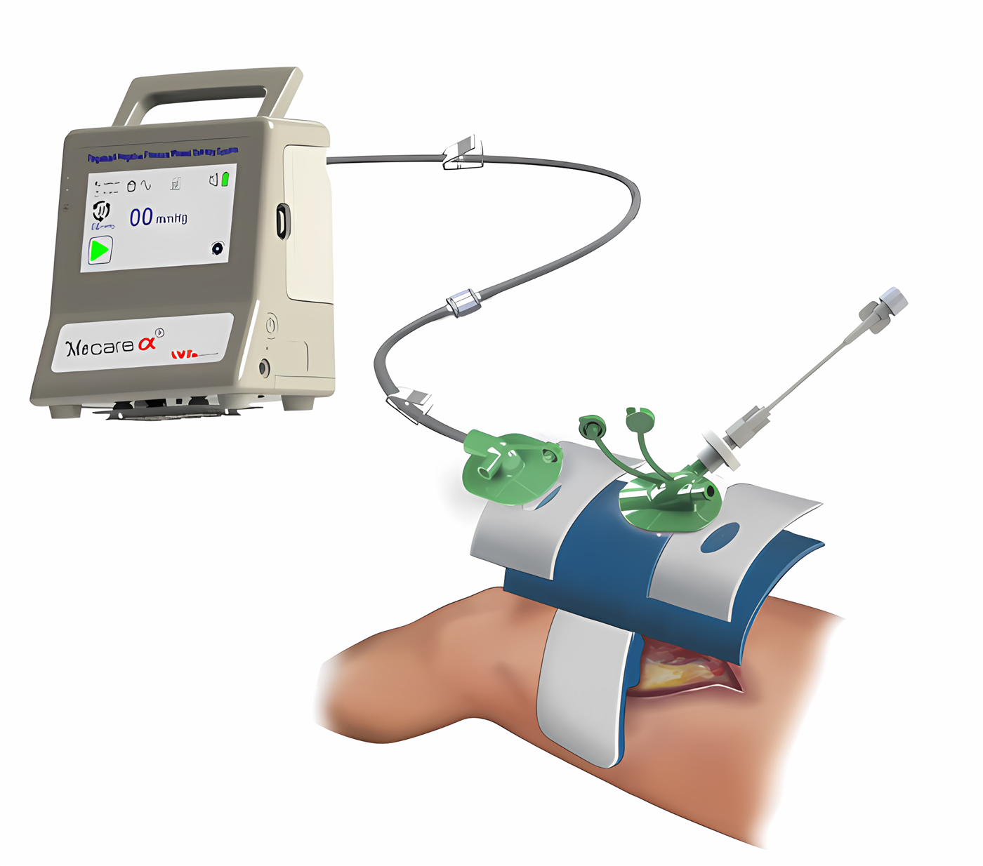 MeCare α® connected to a wound dressing, ROI-NPT treatment illustration