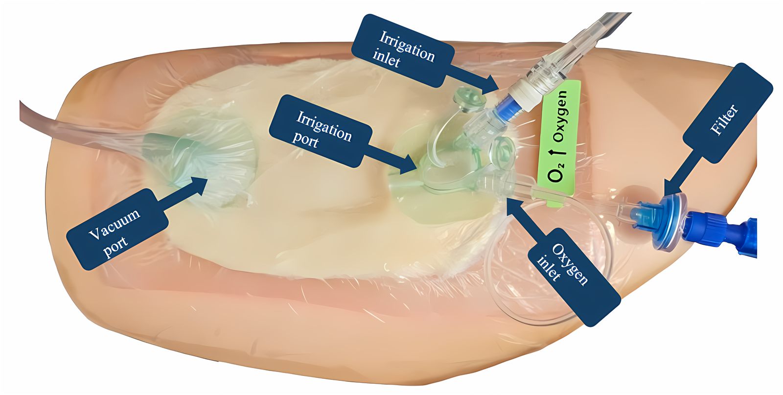 ROINPT wound dressing with vacuum port, irrigation port and oxygen inlet